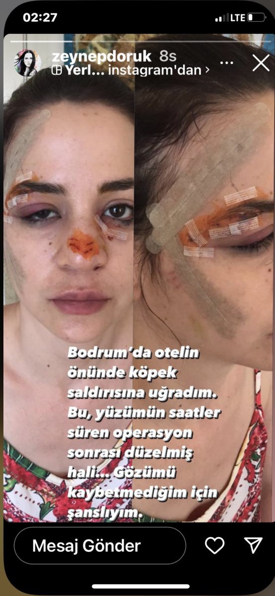 Şarkıcı Zeynep Doruk’a sokak köpeği saldırdı #1